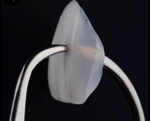 DENTAL VENNERS (2)